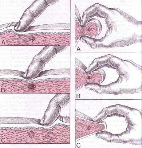 trigger point